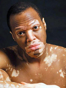 TCM Treatment for vitiligo