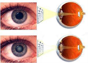 TCM Treatment for senile cataract