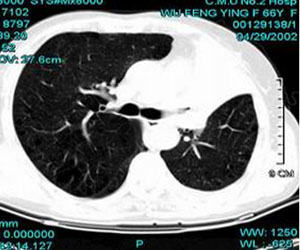 TCM Treatment for idiopathic pulmonary hemosiderosis