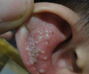 TCM Treatment for eczema of external ear