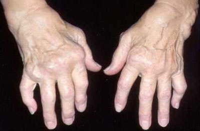 TCM Treatment for degenerative arthritis