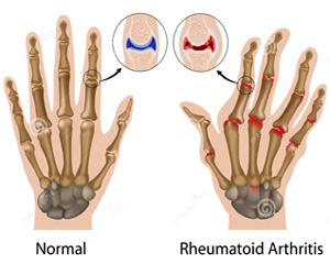 Rheumatism and Arthritis