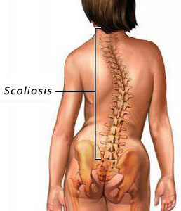 TCM Treatment for scoliosis