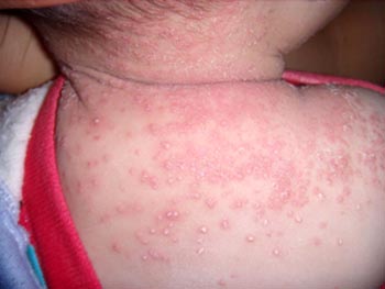 definition of eczema in tcm