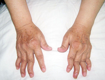 definition of rheumatoid arthritis in tcm