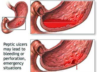 definition of peptic ulcer in tcm