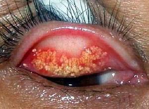 definition of trachoma in tcm