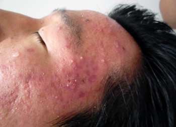 definition of acne in tcm