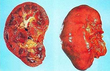 definition of acute nephritis in tcm