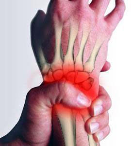 definition of carpal tunnel syndrome