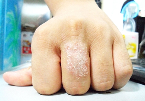 tcm herbal formula helps to fight against eczema