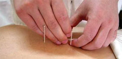 Acupuncture Manipulating Methods