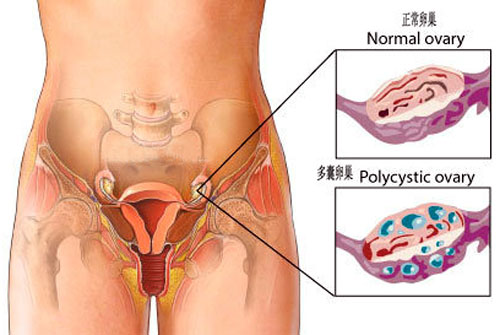 positive suggestions to treat and prevent polycystic ovaries