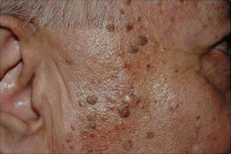 home remedies known to help in the removal of age spots