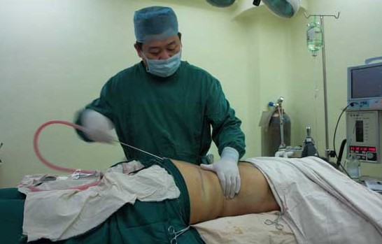 liposuction information, the reasons for liposuction