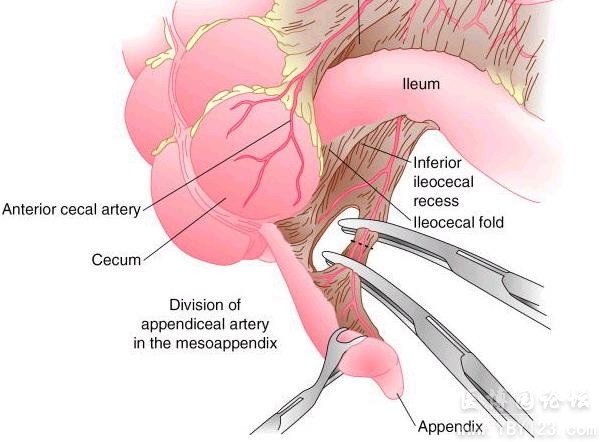 appendectomy surgery, appendicitis symptoms, treatment