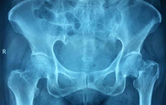 hip replacement surgery, avascular necrosis, bone tumor