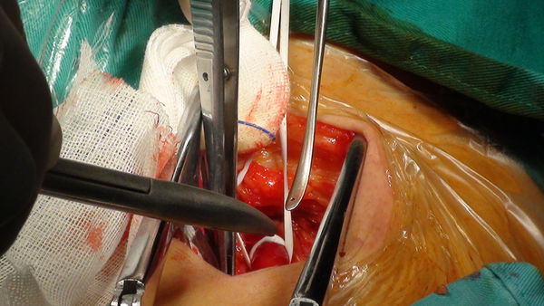 angioplasty surgery, coronary angioplasty, risks of angioplasty