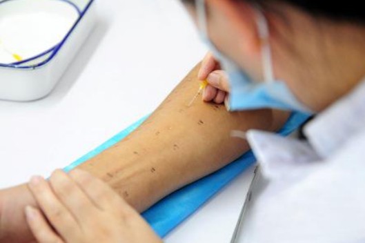 allergy skin test technique, intradermal test, patch test, scratch test