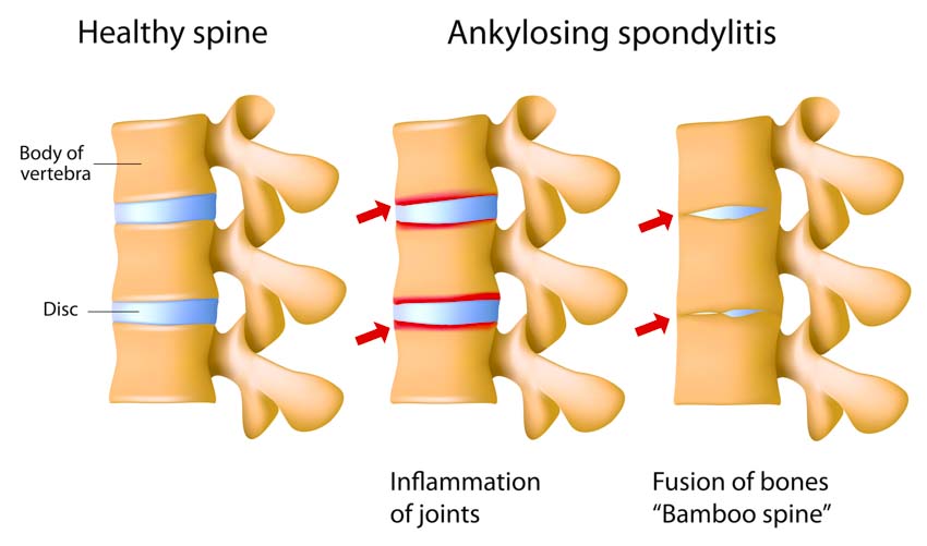 acupuncture provides relief for patients with ankylosing spondylitis
