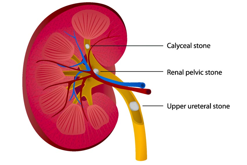 acupuncture assists in the elimination of kidney stones