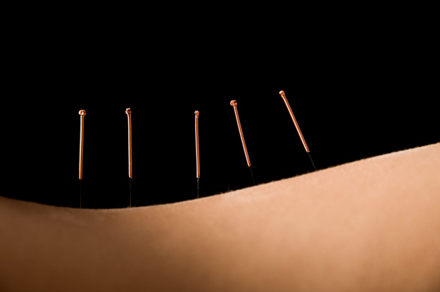 acupuncture points and herbs used to treat shingles