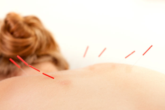 can acupuncture prevent and treat migraine headaches?