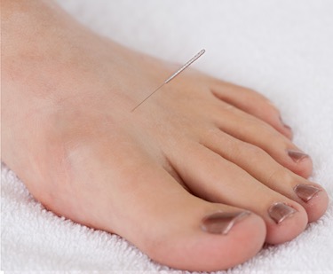 acupuncture lowers hypertension with microrna
