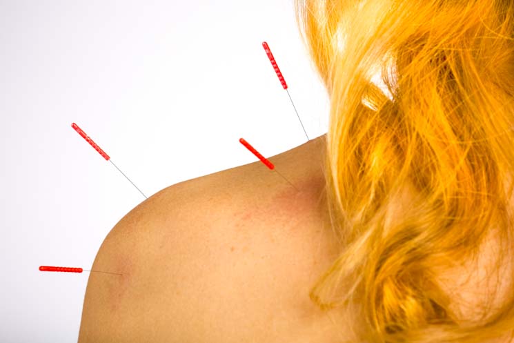 acupuncture points used to soothe cervical spinal syndrome