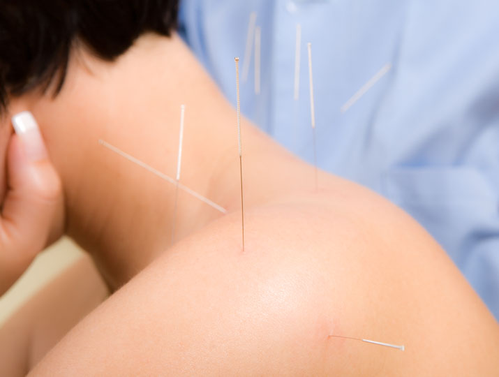 acupuncture effective for cervical spondylotic radiculopathy