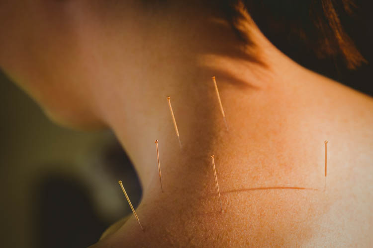 acupuncture for alleviating cognitive dysfunction