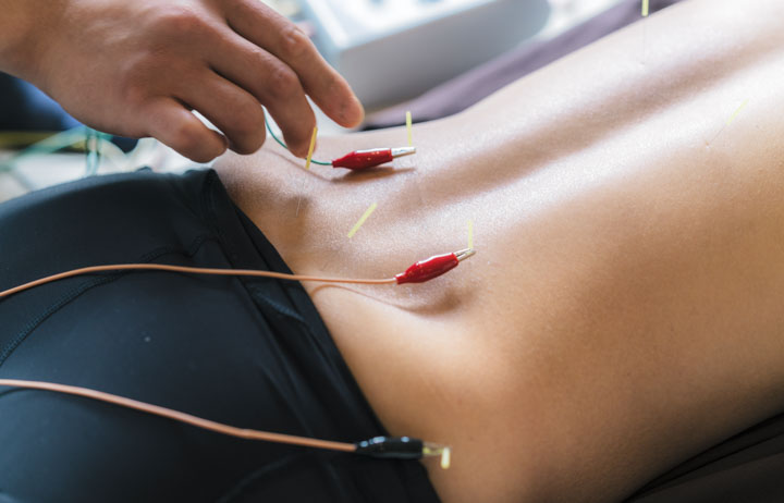 acupuncture widely used for the treatment of back pain