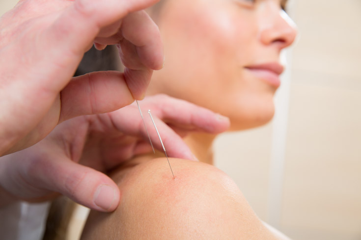 acupuncture is helpful for patients with frozen shoulder