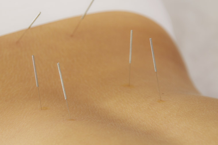 acupuncture helps in restoring endogenous estrogen production