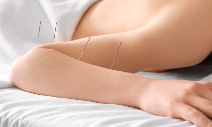 acupuncture, an effective treatment for paralysis caused by stroke